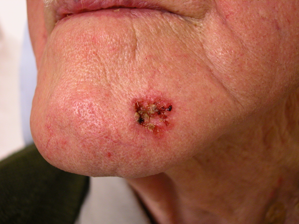 Chin Squamous Cell Carcinoma