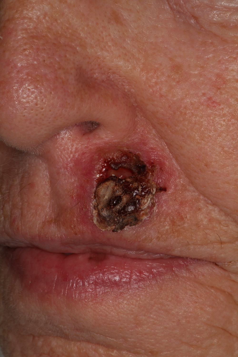 Lip Squamous Cell Carcinoma