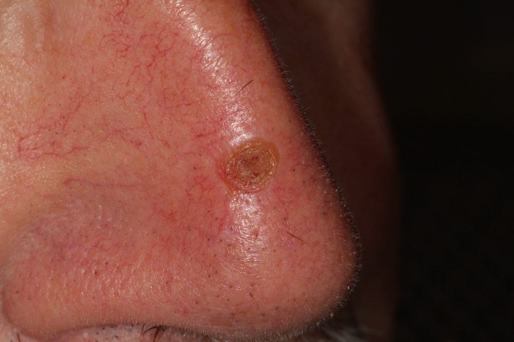 Nose Basal Cell Carcinoma